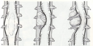 spinal-cord-tumors