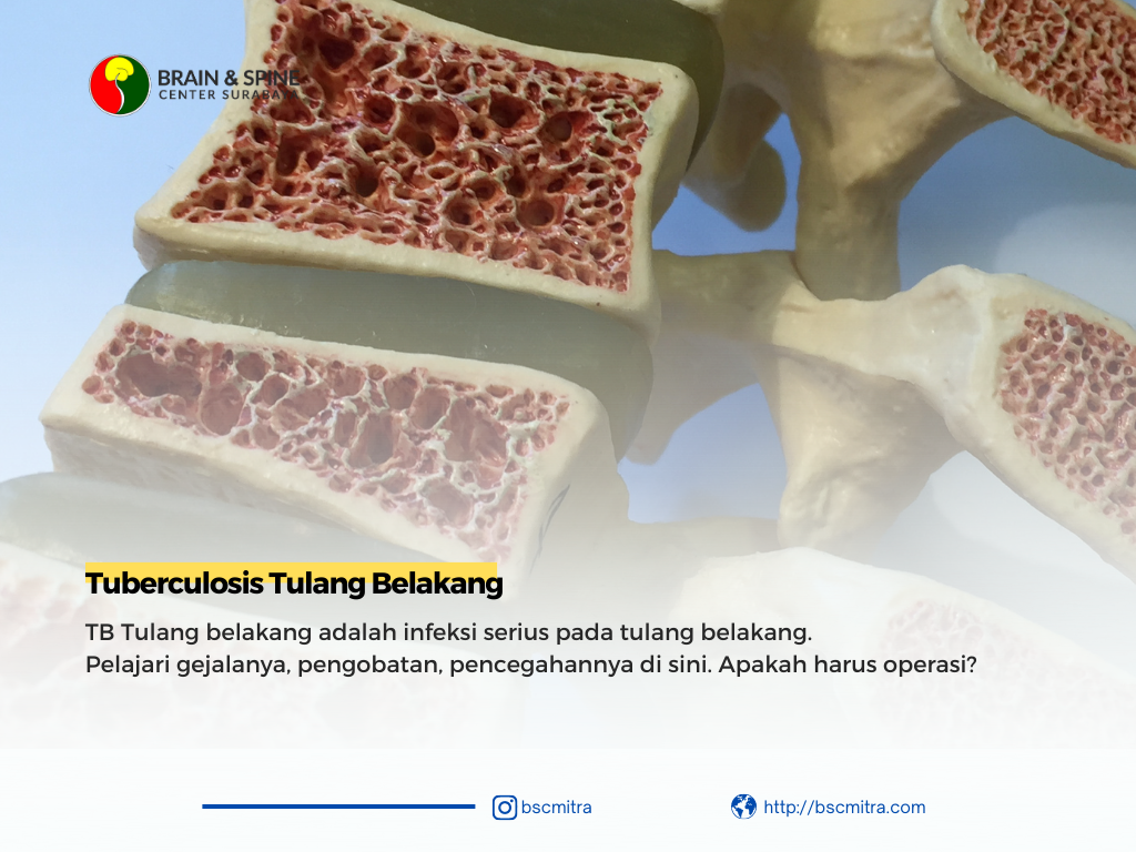 TB Tulang Belakang: Mengenal Infeksi pada Tulang Belakang