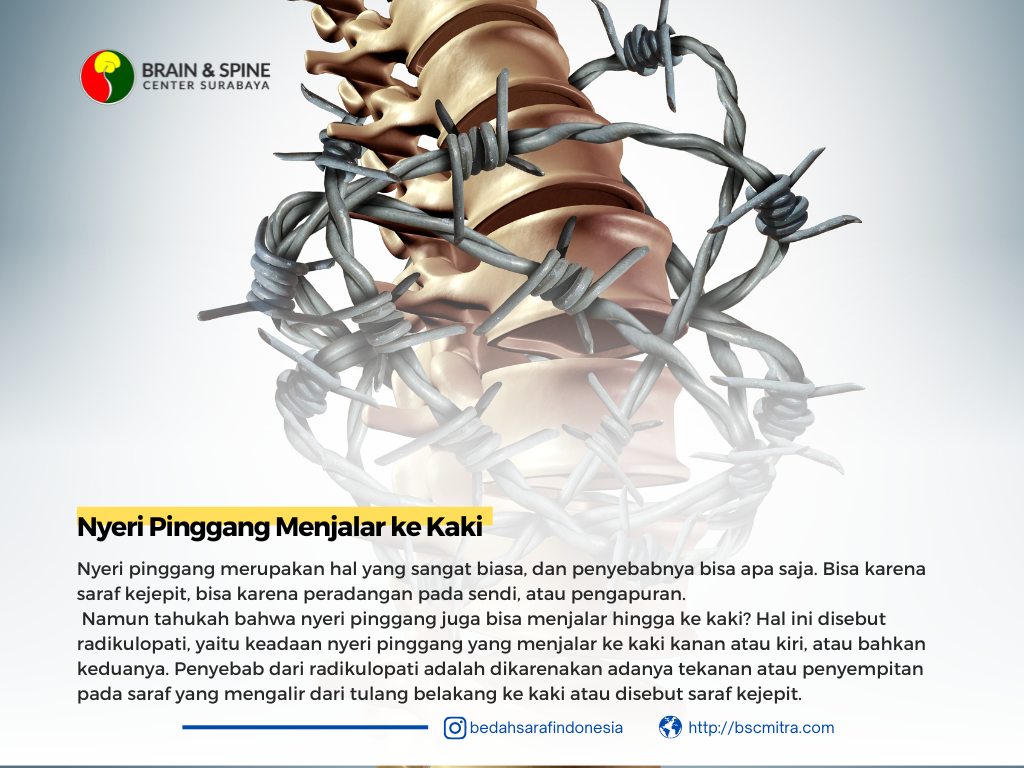 Nyeri pinggang menjalar hingga kaki?