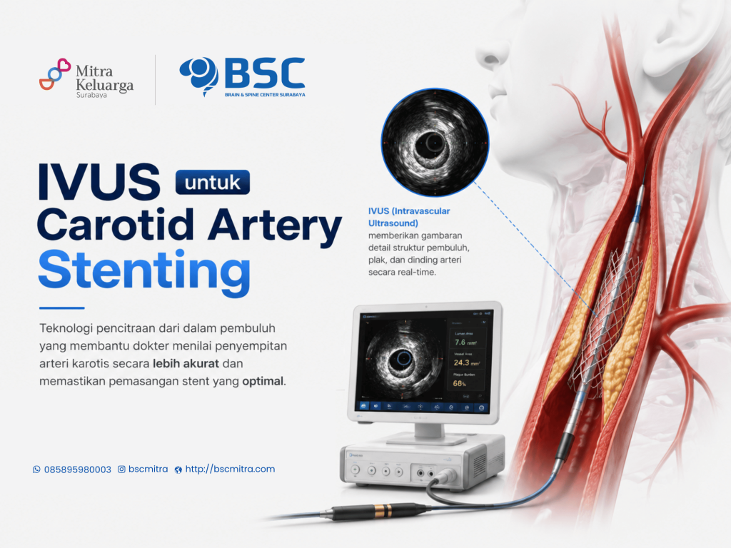 IVUS untuk Carotid Artery Stenting