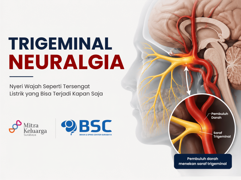 Trigeminal Neuralgia: Penyebab, Gejala, Pengobatan Non Operasi, dan Kapan Harus Operasi