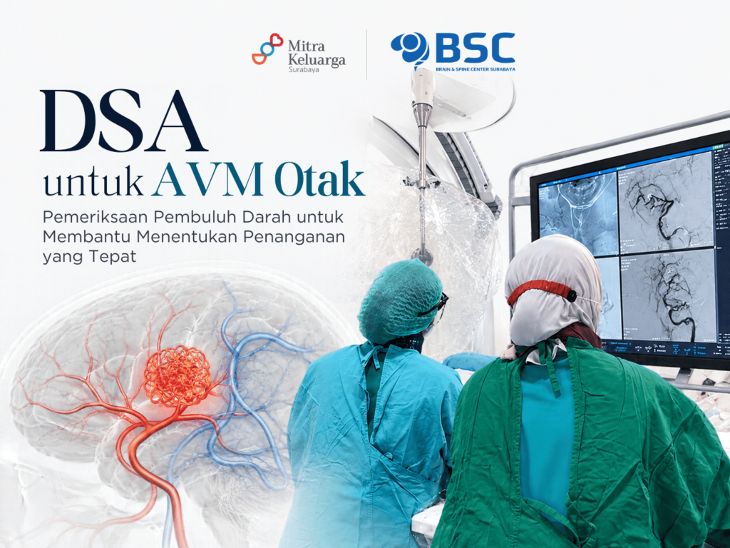 DSA untuk AVM Otak: Pemeriksaan Pembuluh Darah untuk Membantu Menentukan Penanganan yang Tepat
