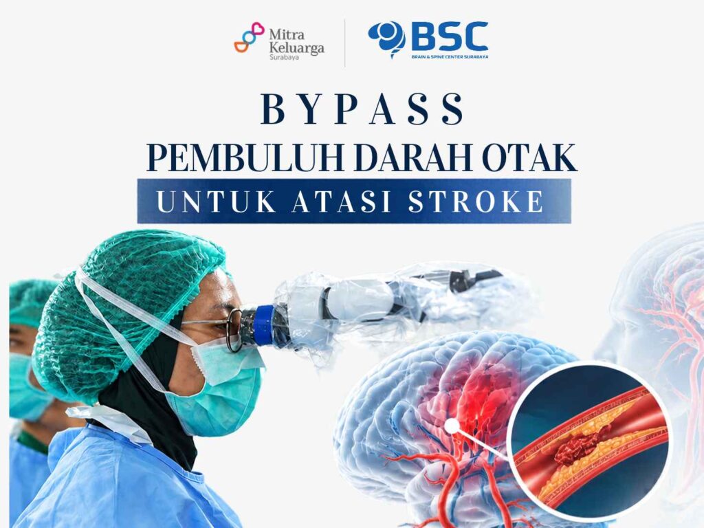 Bypass Pembuluh Darah Otak: Pilihan Penanganan Stroke Akibat Gangguan Aliran Darah