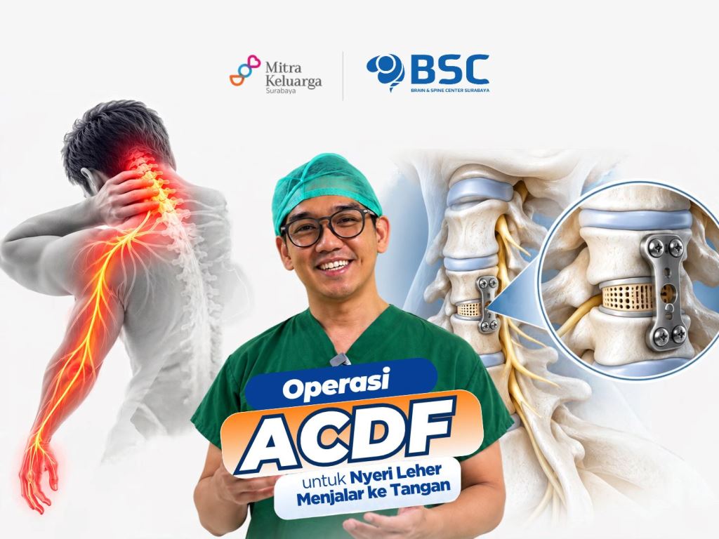 Operasi ACDF untuk Saraf Terjepit di Leher