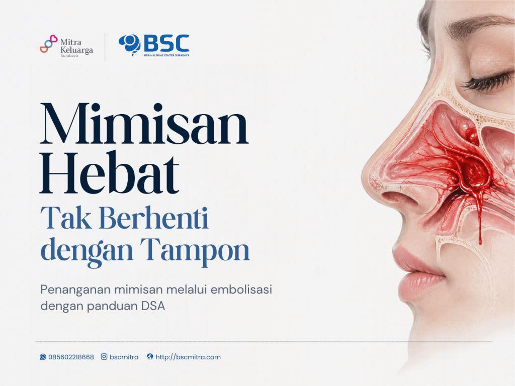 Penanganan Mimisan Hebat: Ketika Tampon Tidak Lagi Cukup