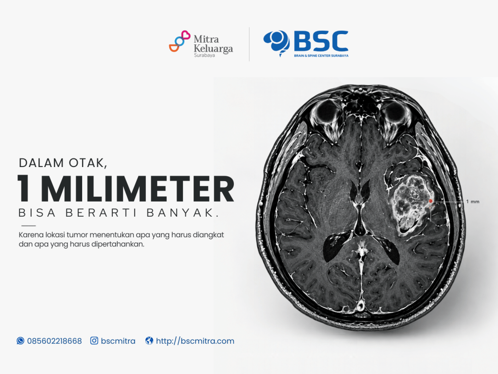 1 Milimeter pada Tumor Otak: Mengapa Presisi Sangat Penting?